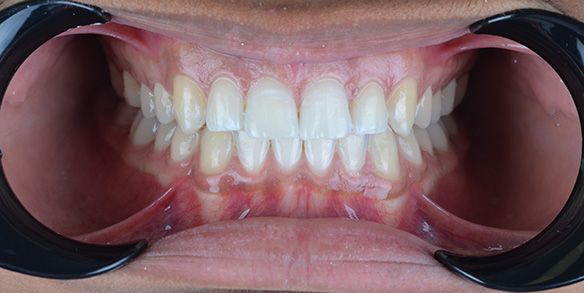 Manuel After Invisalign New Smile