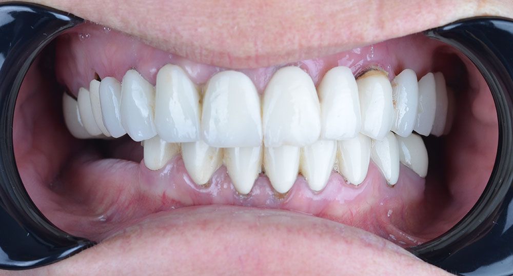 3 Marry all on four dental implants Marry all on four dental implants