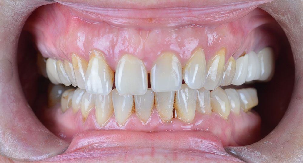 Yusra Zirconium Crowns Treatment