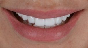 Elena Smilemakeover Turkey Teeth