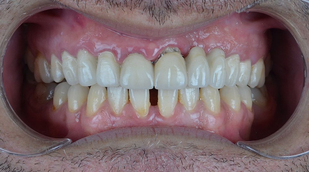 4 Ergunnes Zirconium Crowns Before Ergunnes Zirconium Crowns Before