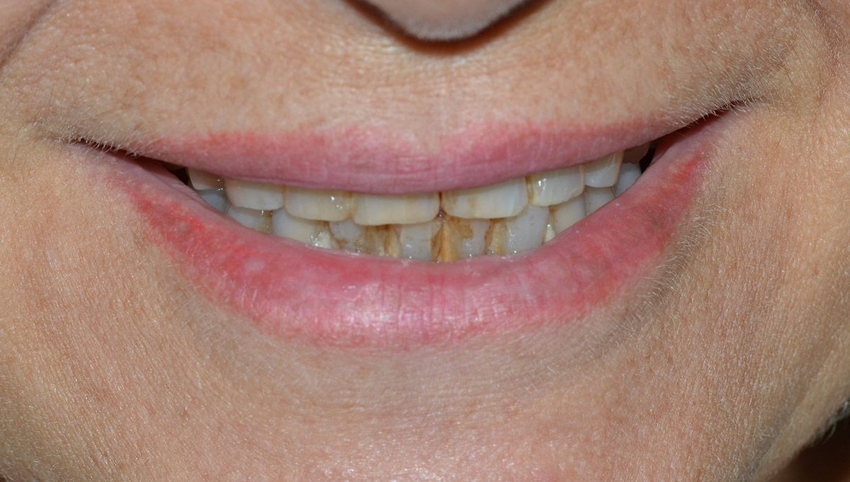 4 Georgiana Zirconium Crowns Treatment Before Georgiana Zirconium Crowns Treatment Before
