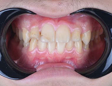 Glenn Invisalign Before Turkey sp fr