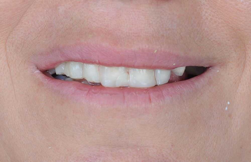 Hazal Zirconia Crowns Treatment