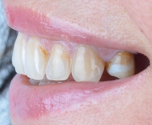 Isabella Missing Tooth Dental Implants Metal Porcelain Crowns