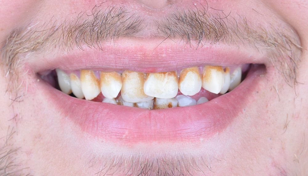 Jacob Zirconium Crowns Treatment in Turkey Before