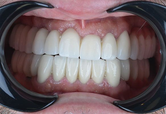 Jonah Turkey Veneers Jonah Turkey Veneers