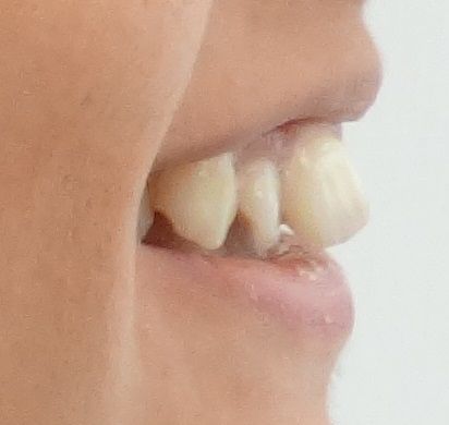 Luna Before Invisalign Re