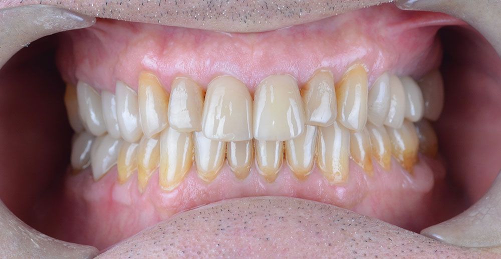Maciej emax laminate smile makeover treatment in Turkey