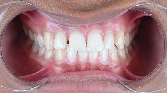 Manuel Before Invisalign Front