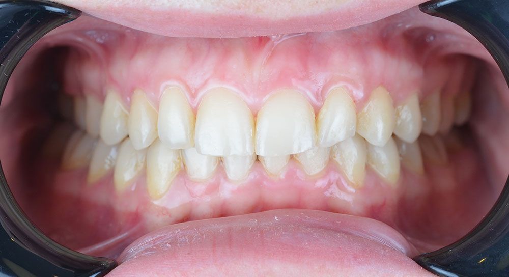 Melissa Clear Aligner Treatment After