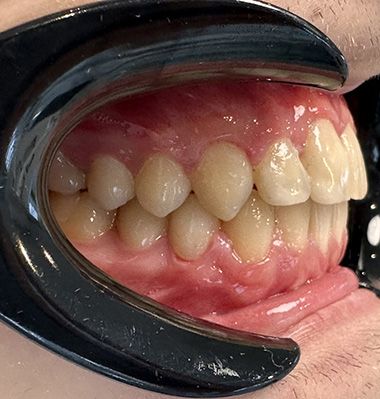 Glenn Invisalign After Smile Rear sp