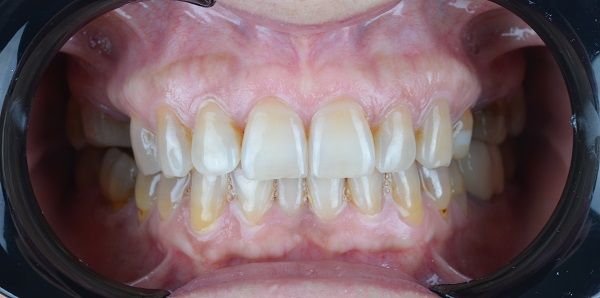 Isabella Missing Tooth Dental Implants Metal Porcelain Crowns