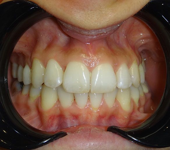 Luna After  Invisalign Sp Fr