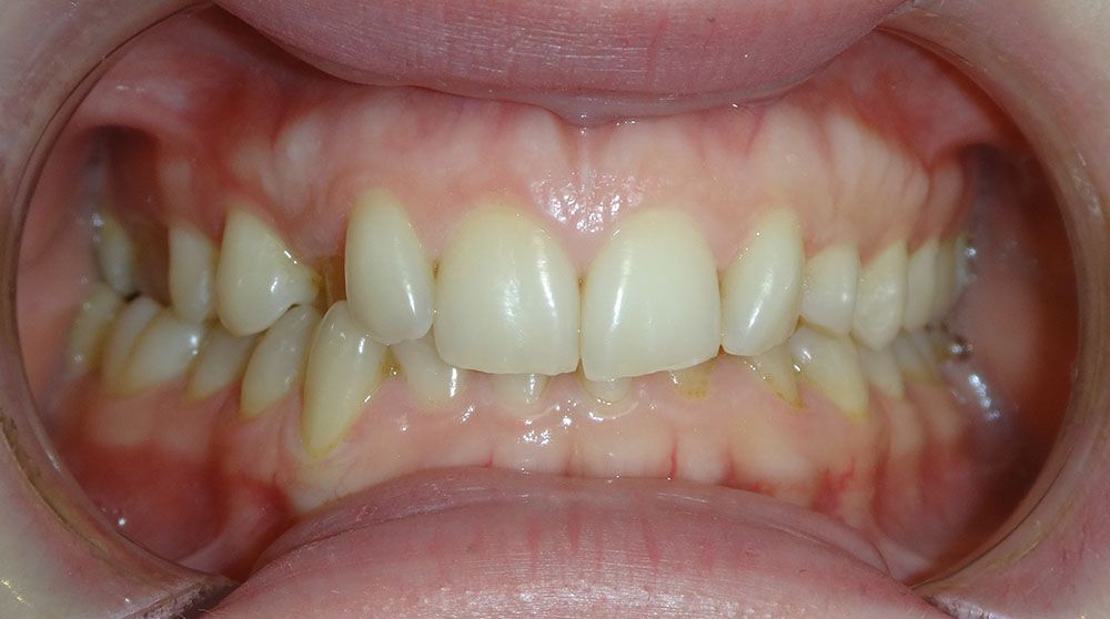 Melissa Clear Aligner Treatment Before