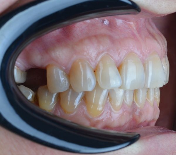 Isabella Missing Tooth Dental Implants Metal Porcelain Crowns