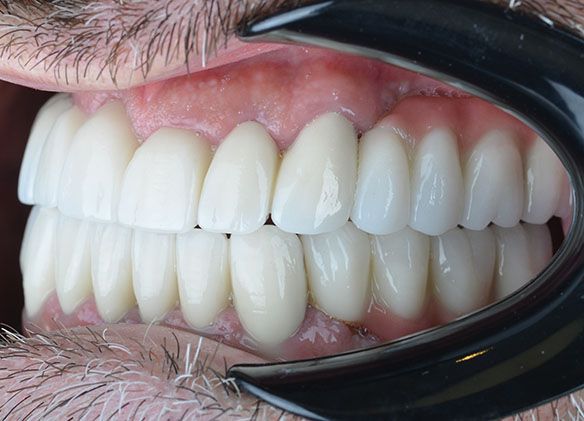 Jonah Turkey Teeth Jonah Turkey Teeth