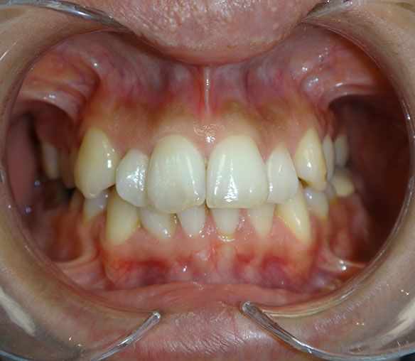 Luna Before Invisalign Sp Fr