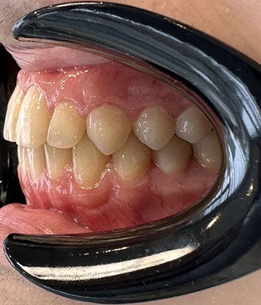 Glenn Invisalign After Smile Rear2