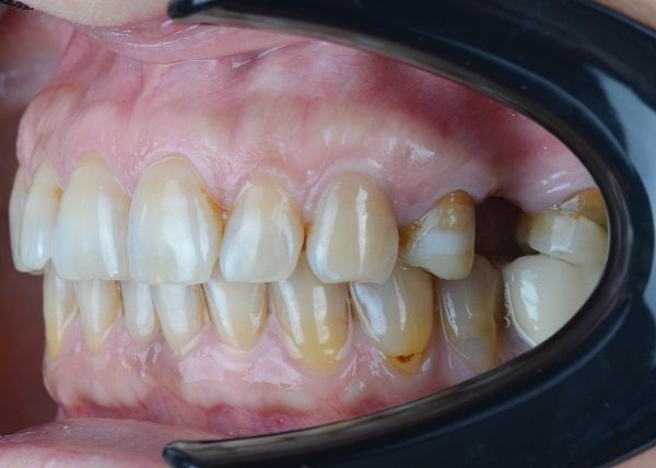 Isabella Missing Tooth Dental Implants Metal Porcelain Crowns