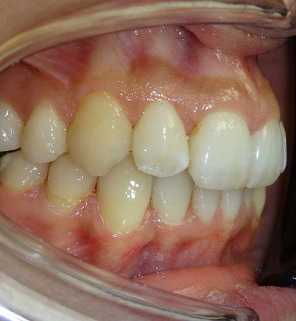 Luna After Invisalign Sp Re