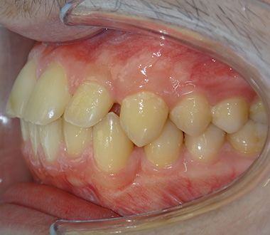 Glenn Invisalign Before Smile Rear2