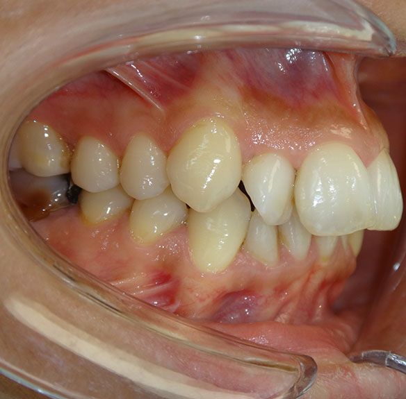 Luna Before Invisalign Sp Re