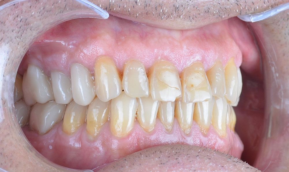 Maciej emax laminate smile makeover treatment in Turkey