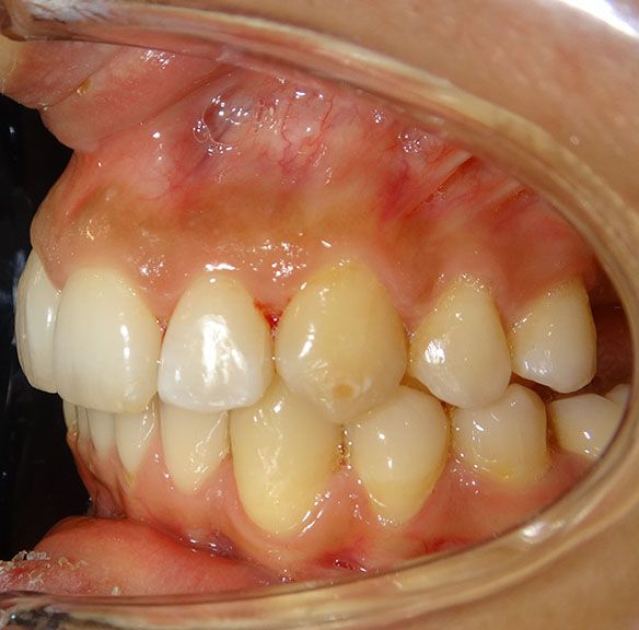 Luna After Invisalign Sp Re2