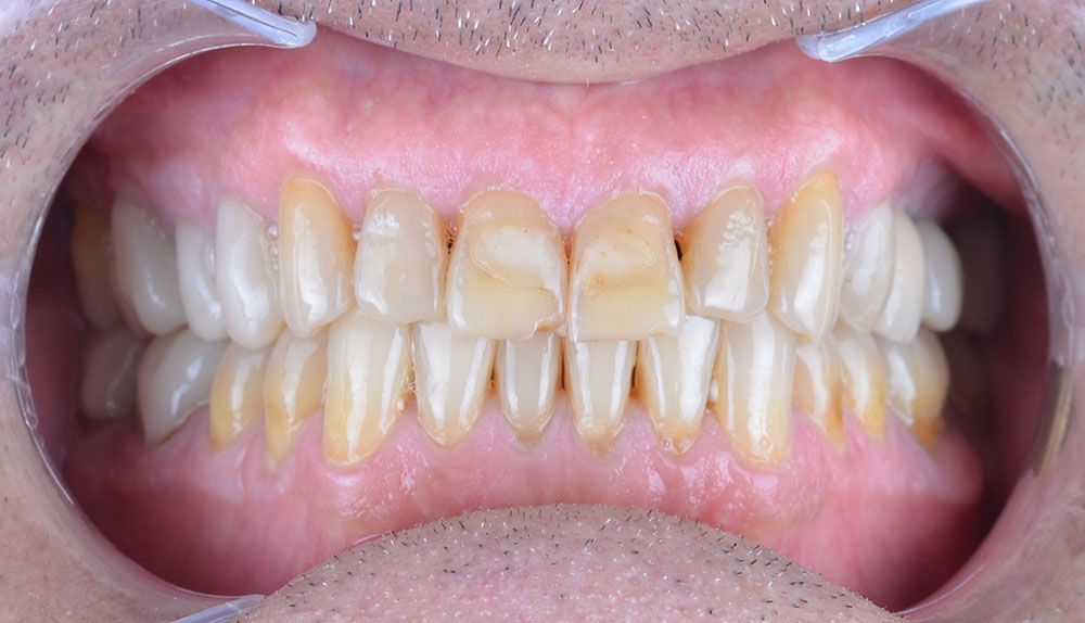 Maciej emax laminate smile makeover treatment in Turkey