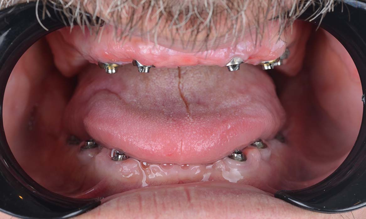 Adam Dental Implant Before Healing Adam Dental Implant Before Healing