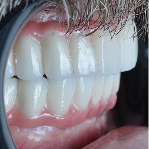Adam Dental Implants After Re Adam Dental Implants After Re