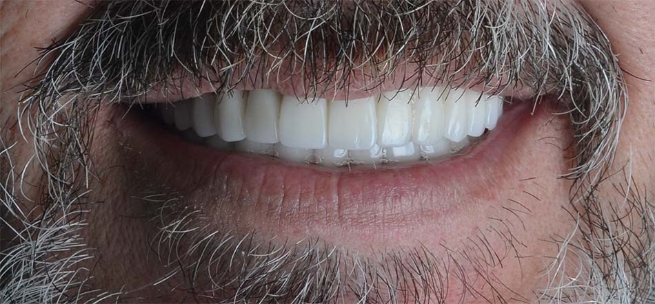 Adam Dental Implants After Adam Dental Implants After