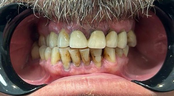 Adam Dental Implants Before Fr Adam Dental Implants Before Fr