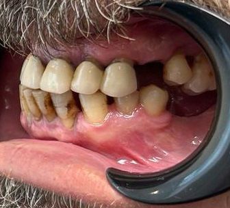 Adam-Dental-Implants-Berofe-Re