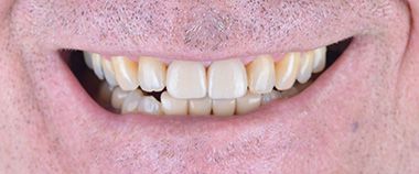 Brian Dental Implants Smile in Turkey