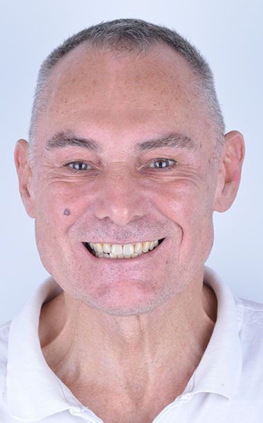 Brian Dental Implants Smile in Turkey