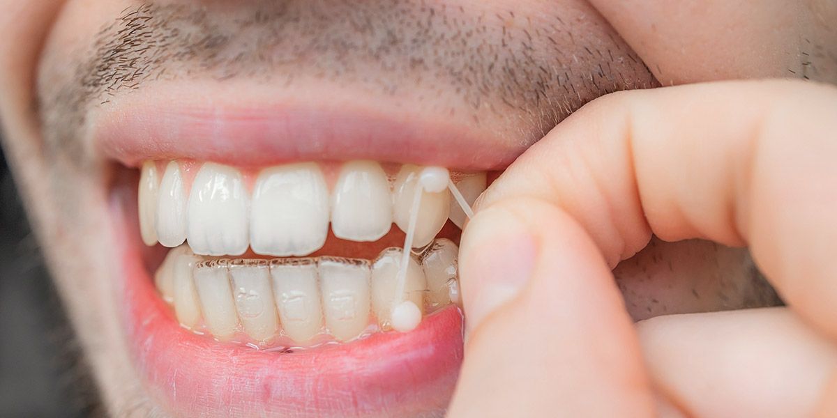 Intraoral Elastics for Aligners