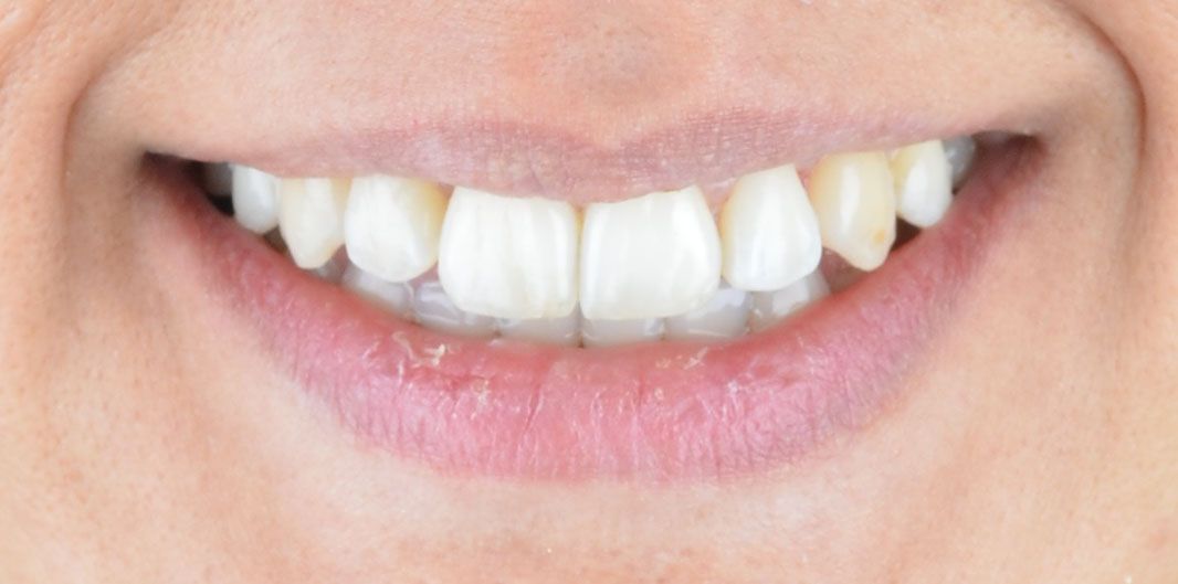 Luna Invisalign After