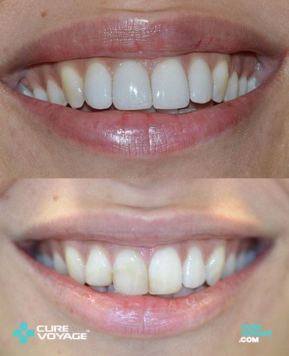 Zirconium Crowns Smile Makeover Before After
