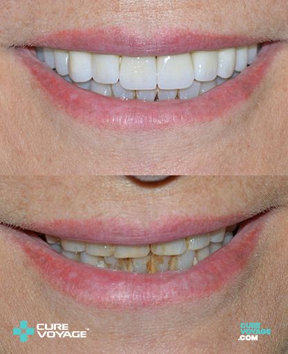 Zirconium Crowns Smile Makeover Before After