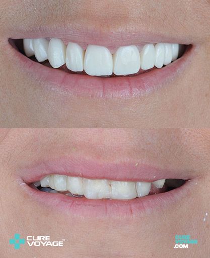Zirconium Crowns Smile Makeover Before After