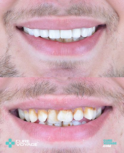 Zirconia Crowns Before After
