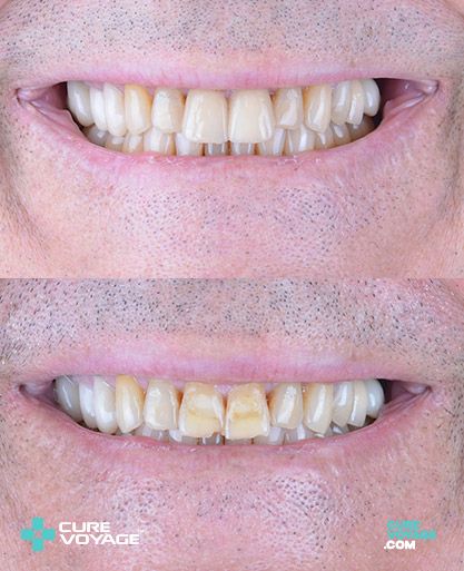 Emax Laminate Veneer Smile Makeover
