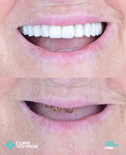 Dental Implants Zirconium Crowns Before After
