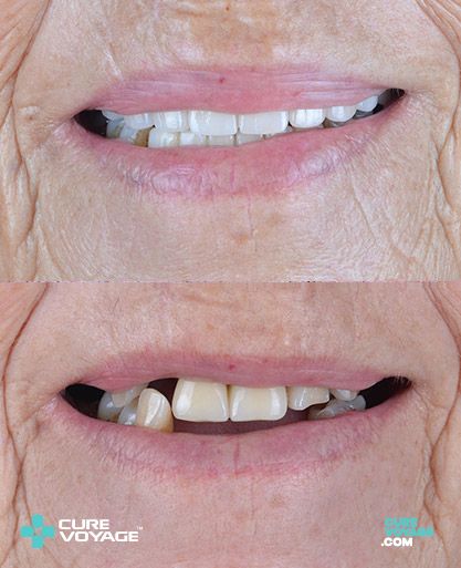 All on Four Treatment Before After