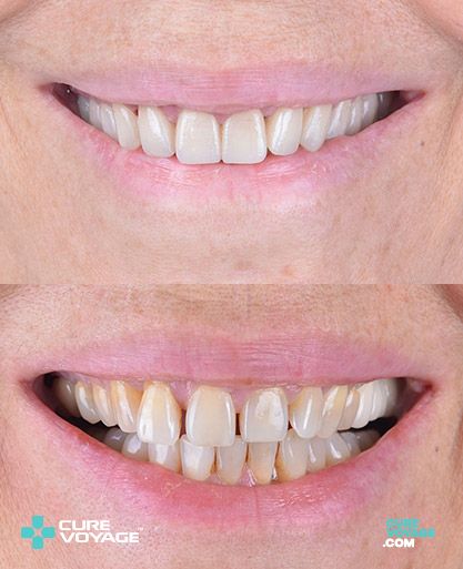Zirconium Crowns Smile Makeover Before After