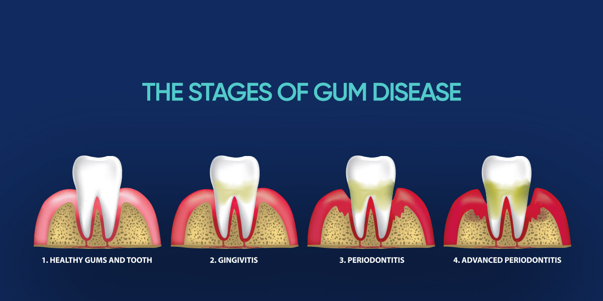 Stages of Gum Disease