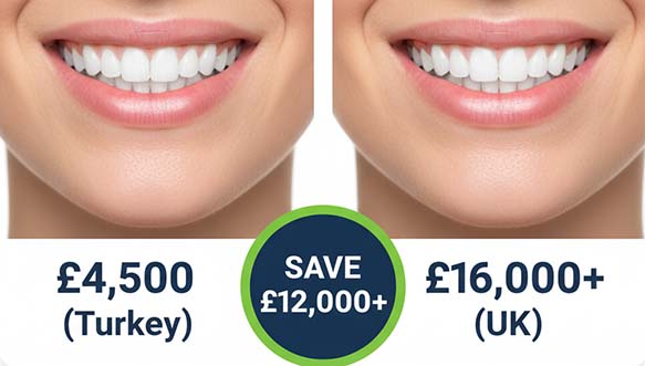 Veneer cost comparison: a perfect smile for £4,500 in Turkey vs. £16,000+ in the UK, saving over £12,000.