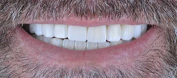 Jonah Dental Implants Smile in Turkey